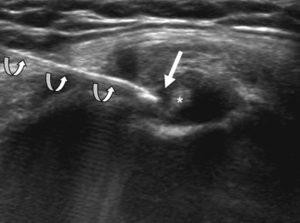 ultrasound-injection-real-image